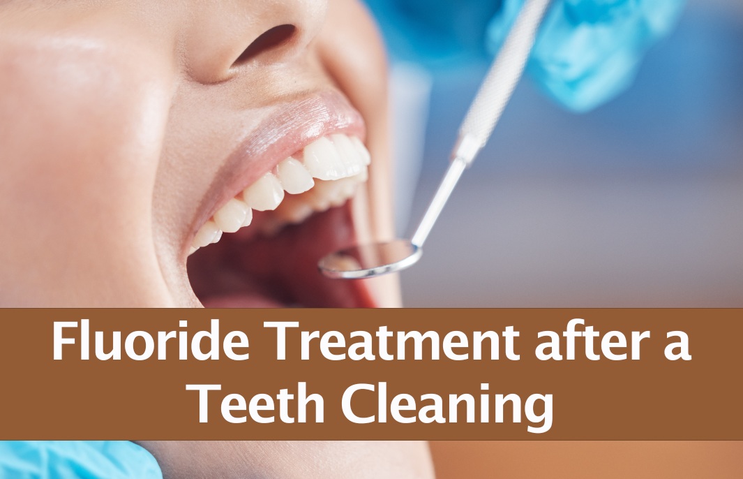 Do You Need Fluoride Treatment After A Teeth Cleaning do-you-need-fluoride-treatment-after-a-teeth-cleaning